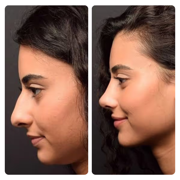 Nose Aesthetics (Rhinoplasty) in Turkey